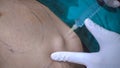 Local anesthesia,Body Liposculpture Procedure,Fat removal.