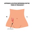The location of the appendix depends on the term of pregnancy. Up to 3 months. Infographics. Vector illustration