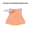 Location of the appendix under the liver. The appendix under the liver. Infographics. Vector illustration on isolated background.