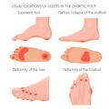 Location of the Diabetic foot ulcers Royalty Free Stock Photo