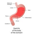 Location of Gastritis, body of it, an inflammation of the lining of the stomach. Three types Antral, of the body and pangastritis