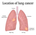Location of lung cancer Royalty Free Stock Photo