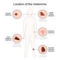 Location of the melanoma. Close-up of malignant skin cancer