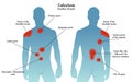 Location of pain of calculosis