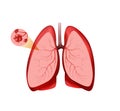 Location pulmonary alveoli clipart. Pink lungs with red vessels and healthy bronchial vesicles good breathing.