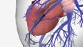 Pulmonary Embolus Blocks Blood Flow