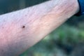 Lone star tick crawling through arm hair on human skin Royalty Free Stock Photo