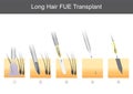 Long Hair FUE Transplant.