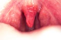 Long uvula with inflammation of infections and viruses. Treatment of uvulitis in children and adults. Sore throat, sore