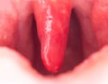 Long uvula with inflammation of infections and viruses. Treatment of uvulitis in children and adults. Sore throat, sore