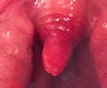 Long uvula with inflammation of infections and viruses. Treatment of uvulitis in children and adults. Sore throat, sore