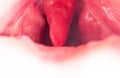 Long uvula with inflammation of infections and viruses. Treatment of uvulitis in children and adults. Sore throat, sore