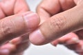 Longitudinal ridging nail on fingernail ( vertical nail ridges). Royalty Free Stock Photo