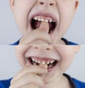 Before and after. Loose baby teeth. From above, the boy shows that the milk tooth is not loose. Below is a photo where a temporary