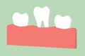 Loose tooth - dental cartoon 3d render