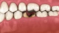 Losing molar tooth. 3D animation of human teeth and dentures