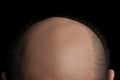 Adult loss health hair alopecia care bald head baldness skin treatment Royalty Free Stock Photo