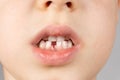 Loss of milk teeth in children. A six-year-old child shows the first baby tooth that has fallen out Royalty Free Stock Photo