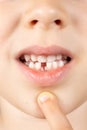 Loss of milk teeth in children. A six-year-old child shows the first baby tooth that has fallen out Royalty Free Stock Photo