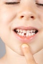 Loss of milk teeth in children. A six-year-old child shows the first baby tooth that has fallen out Royalty Free Stock Photo