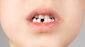 Loss of milk teeth in children. A six-year-old child shows the first baby tooth that has fallen out Royalty Free Stock Photo