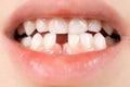 Loss of milk teeth in children. A six-year-old child shows the first baby tooth that has fallen out Royalty Free Stock Photo