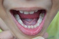 Lost milk tooth boy, new teeth coming Royalty Free Stock Photo