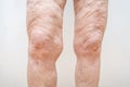 A lot of excess loose skin on legs of a senior woman after weight loss, gastric bypass surgery