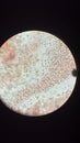 Red blood cell (erythrocytes) in urinalysis