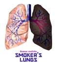 Low poly realistic human lungs and bronchus with cancer inflammation disease. Vector.