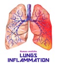 Low poly realistic human lungs and bronchus with cancer inflammation disease. Vector.
