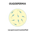 Low sperm count in seminal fluid. Low abundance of sperm in the ejaculate. Male infertility Oligospermia. Spermogram Royalty Free Stock Photo