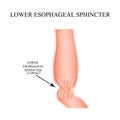 Lower cardiac esophageal sphincter. Infographics. Vector illustration on isolated background.