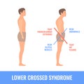 Crooked man with lower crossed syndrome imbalance