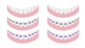 Lower jaw with healthy tooth and dental brace isolated set