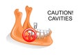 The lower jaw, the teeth, dental caries Royalty Free Stock Photo