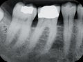 Lower Left Periodontal X-rays