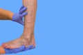 Lower limb vascular examination because suspect of venous insufficiency. Royalty Free Stock Photo
