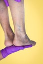 Lower limb vascular examination because suspect of venous insufficiency. Royalty Free Stock Photo