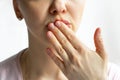 Lower part part of woman face with Red bubbles of virus herpes on her lips, she hides with her palm on white background, Zoster,