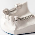 Lower partial denture with attachments