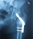 Lt Hip Prosthesis Royalty Free Stock Photo