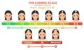 Ludwig scale of androgenic alopecia step poster