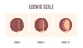 Ludwig scale of baldness in women infographics
