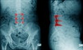 lumbar compression fracture