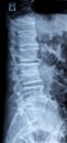 Lumbar disc herniation