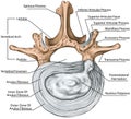 BOARD Lumbar disk herniation Royalty Free Stock Photo