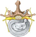 Lumbar disk herniation, nerve root