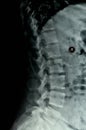 Lumbar lateral x-rays