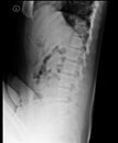 Lumbosacral spine x-ray. Lateral view. Royalty Free Stock Photo